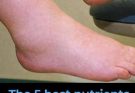 The 5 Best Nutrients to Reduce Swelling in the Feet and Legs